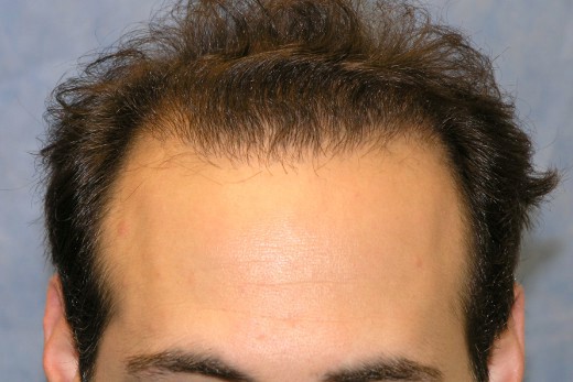 Hair Transplant to a Genetically Receded Hairline